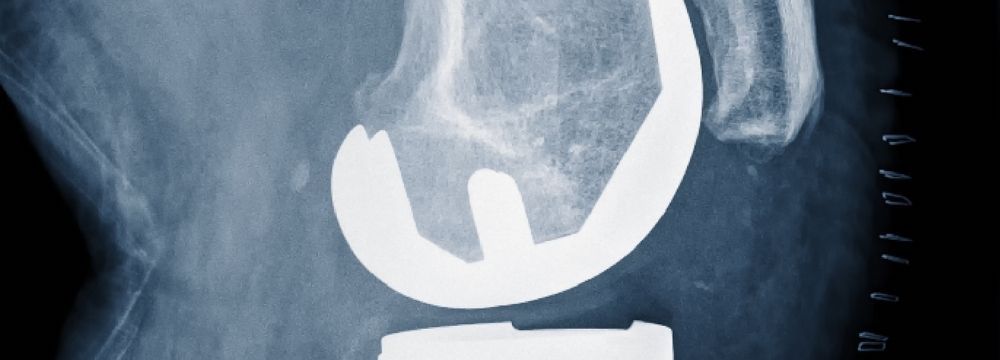 Should You Have Bariatric Surgery for an Orthopedic Procedure?