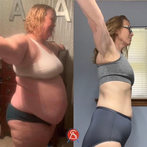 gastric bypass before and after skin